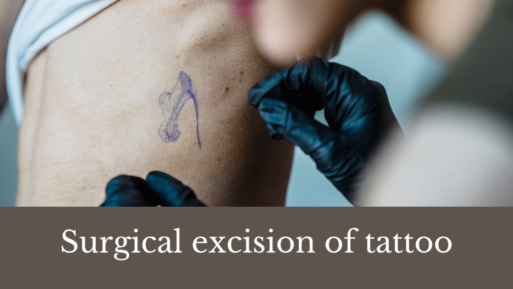 Surgical excision of tattoo
