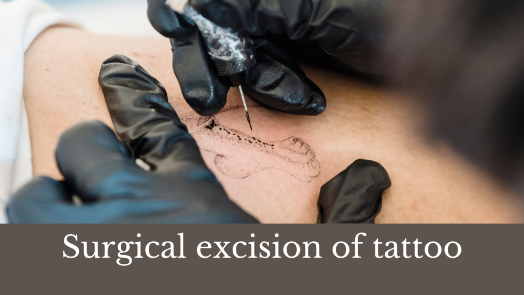Surgical excision of tattoo